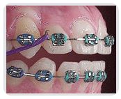 Orthodontic treatment in Delhi, India